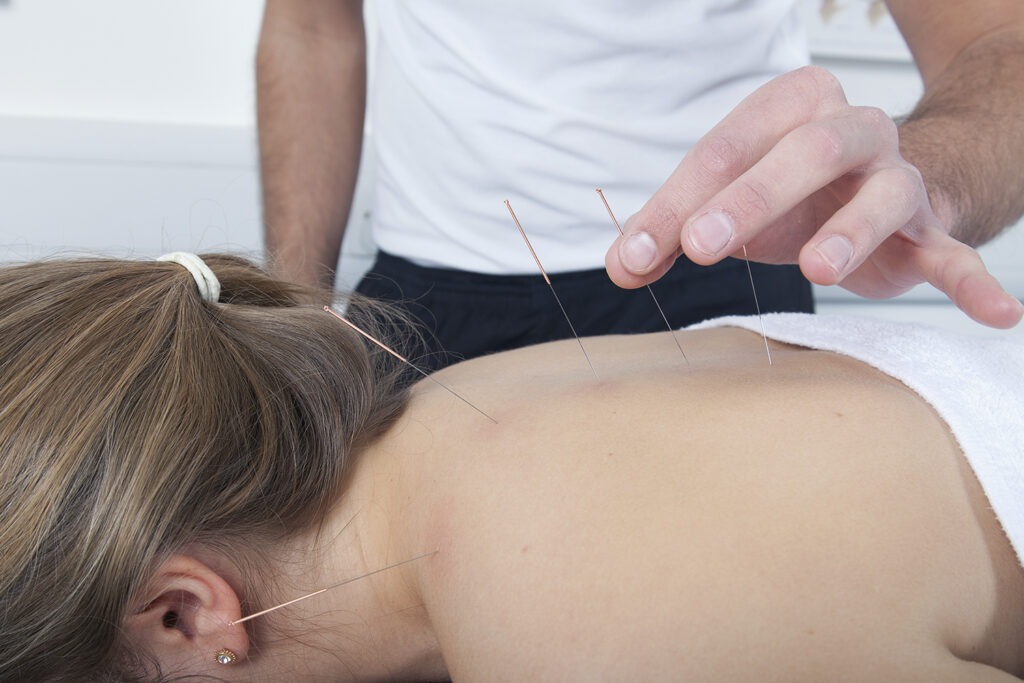 Services Acupuncture Image 1